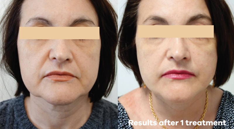 before and after microneedling image